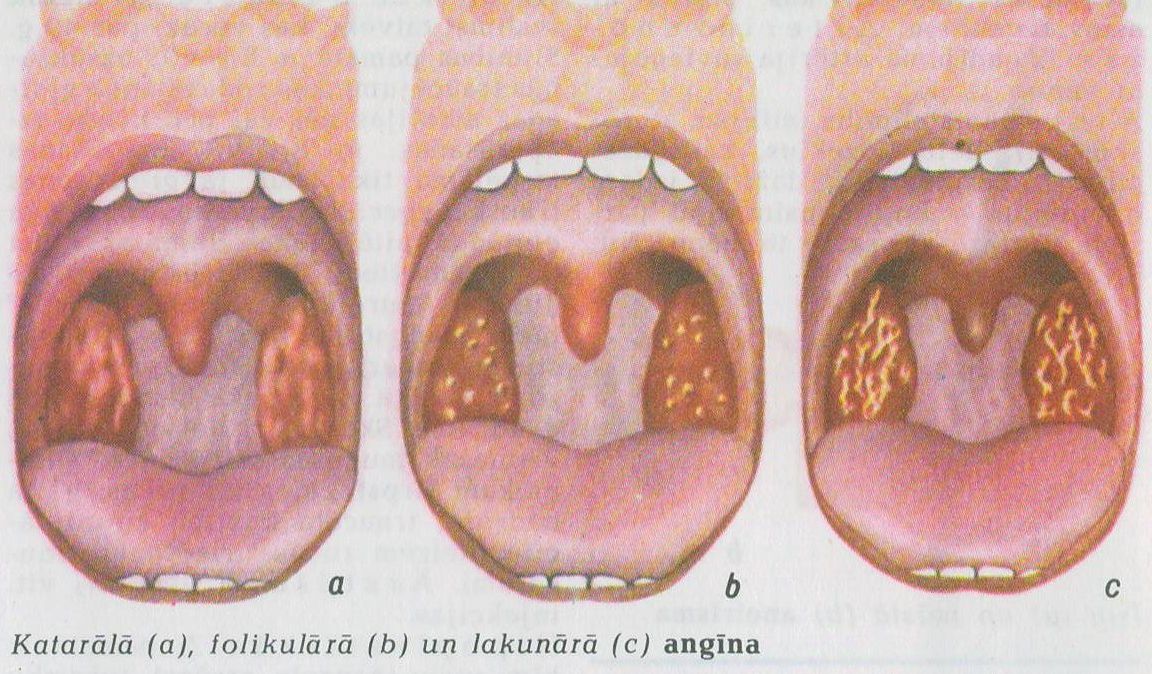 Jak vypadají mandle při angíně?